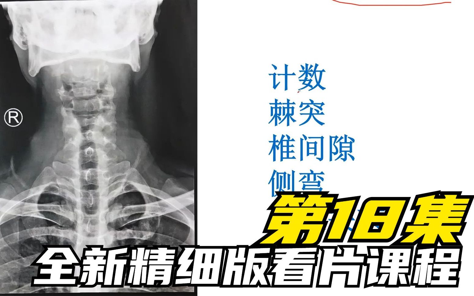 [图]全新精细版看片课程第18集:颈椎影像读片，MR，CT，X光的详细讲解