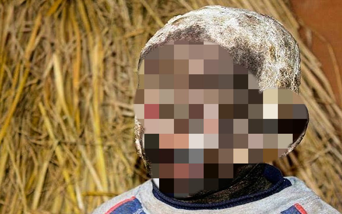 印度男孩患罕见疾病,皮肤僵硬慢慢变成石头…(部分画面引起不适,慎入!