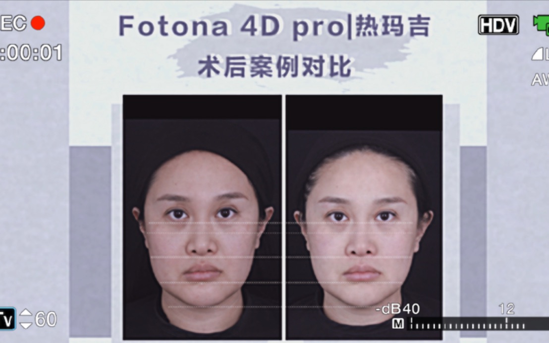 𐟔妈‘想我是疯了!左脸打欧洲之星fotona 4d pro,右脸打热玛吉五代!火爆全网的抗衰热门仪器直观对比!哔哩哔哩bilibili