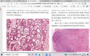 【小崔病理】2，乳腺的浸润性筛状癌（百度一下筛子）