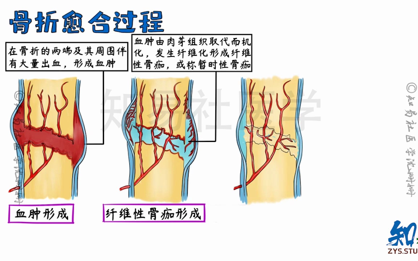 【绘画 病理学】骨折的愈合过程