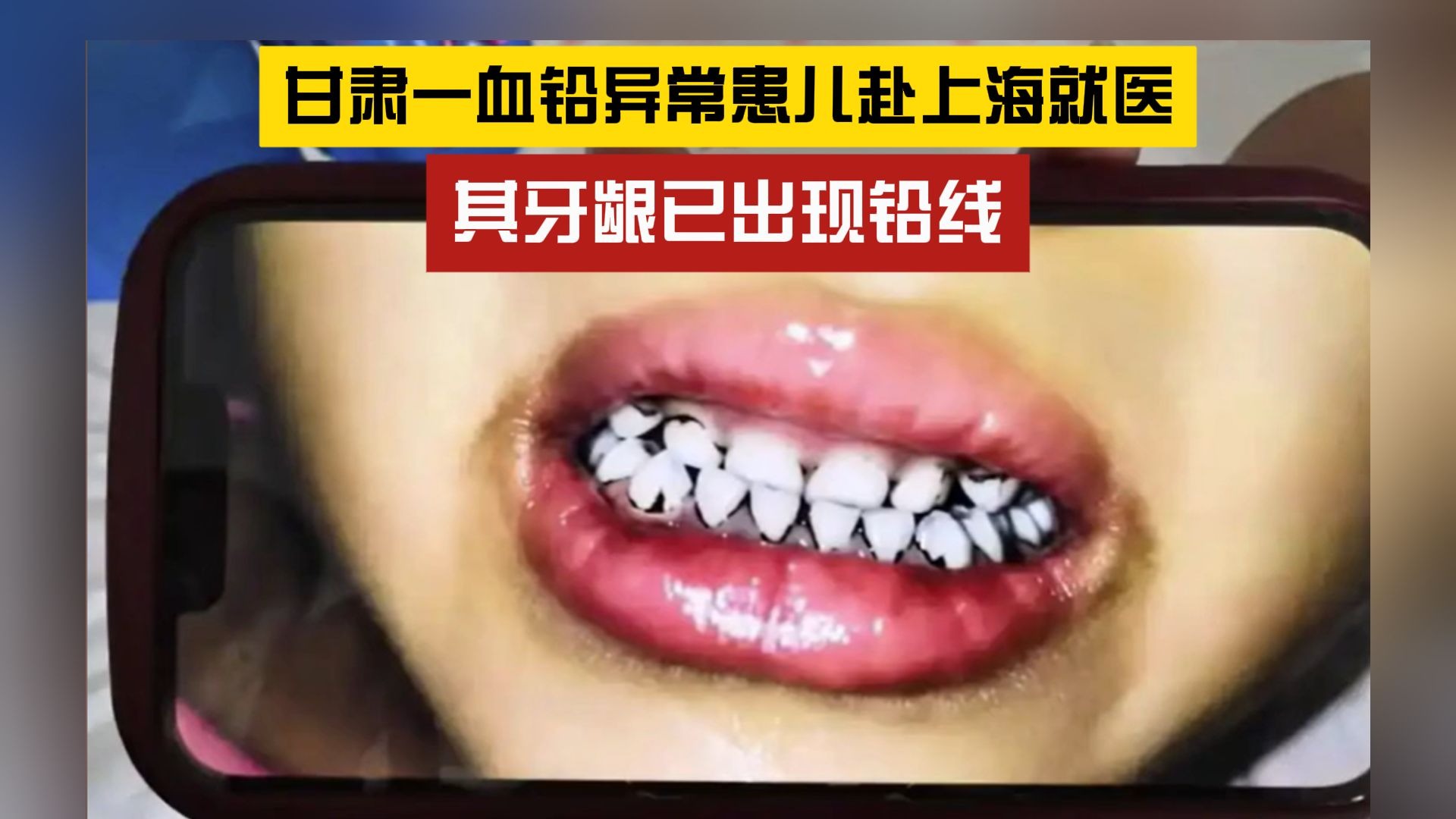 初步判断中毒三个月以上！甘肃一血铅异常患儿牙龈已出现铅线