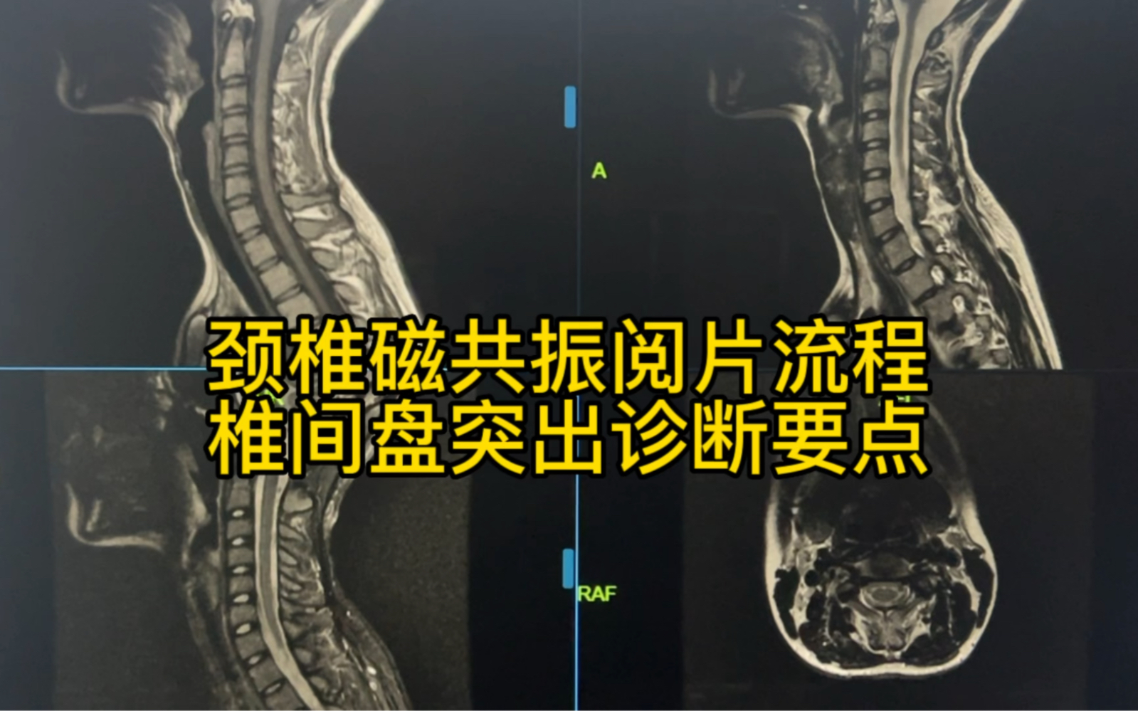 颈椎磁共振阅片流程及椎间盘突出诊断要点