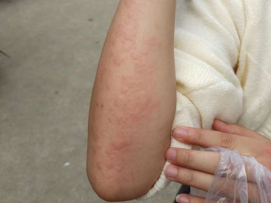 胳膊起大片丘疹痒的难受,一定要操作的三个高效根治的方法,皮肤再也