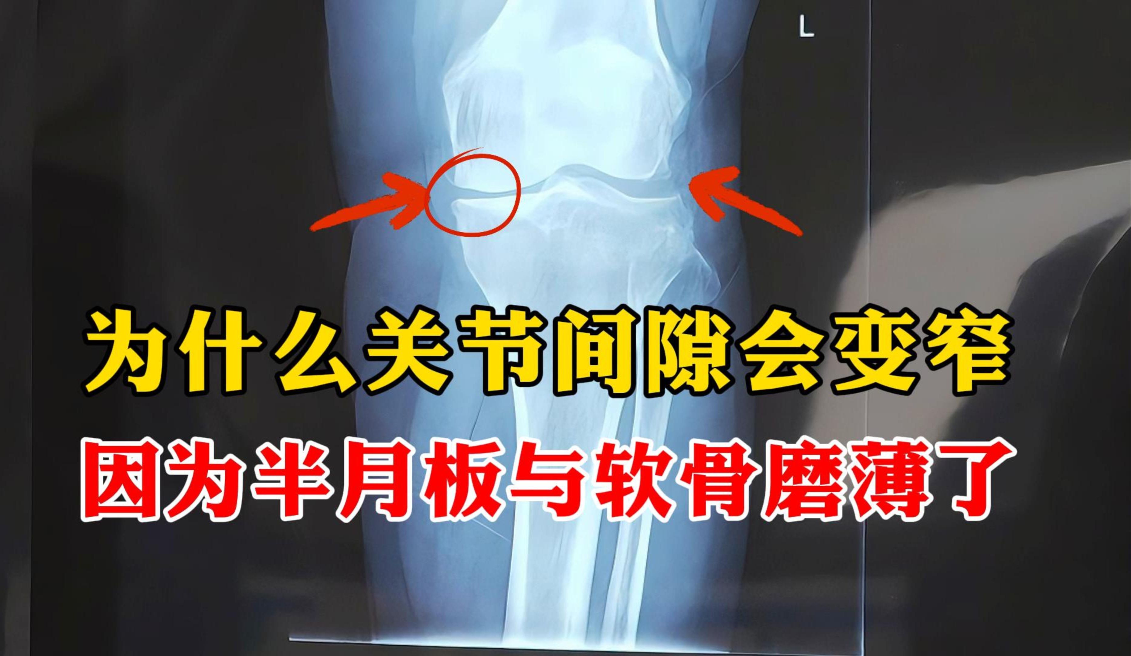 58岁女子,骨关节炎,关节间隙明显变窄,出现骨刺,应如何处理