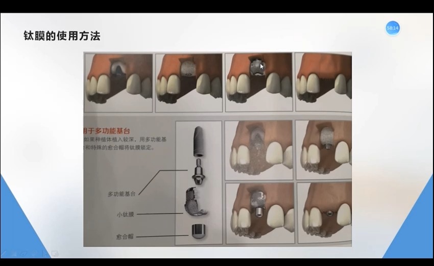 口腔种植工具及材料