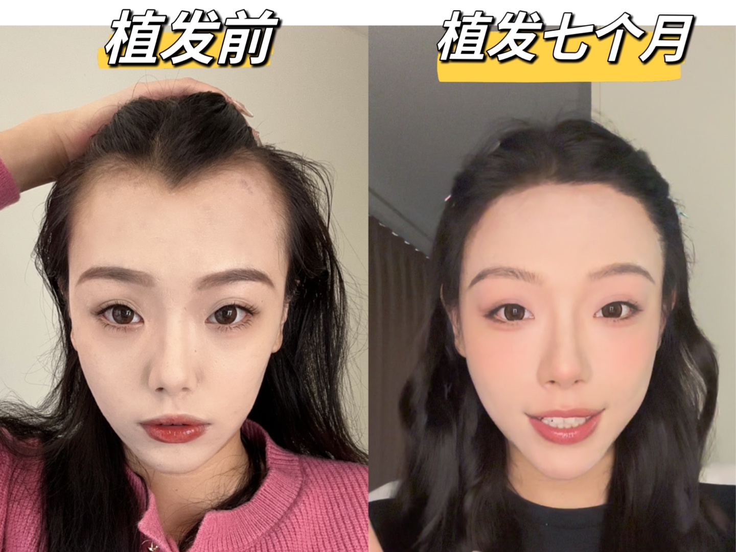 植发合法(植发违法吗)