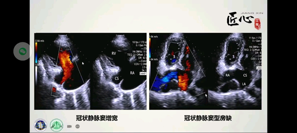 冠状静脉窦型房间隔缺损超声表现哔哩哔哩bilibili