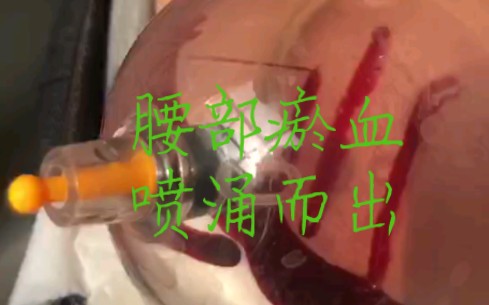 在外婆家给大老爷腰部刺血,效如桴鼓!哔哩哔哩bilibili