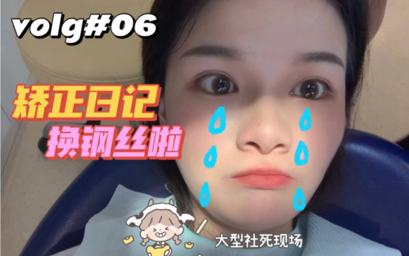 volg|矫正日记 第一次换钢丝啦哔哩哔哩bilibili