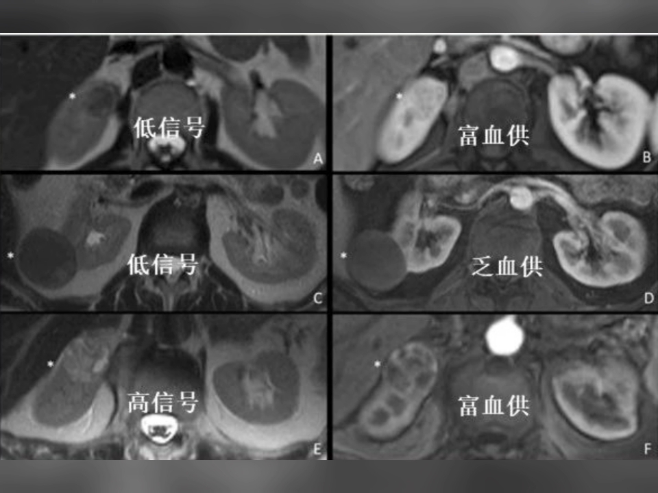 T2抑脂的这种稍高信号提示肾透明细胞癌,比较有特异性.哔哩哔哩bilibili