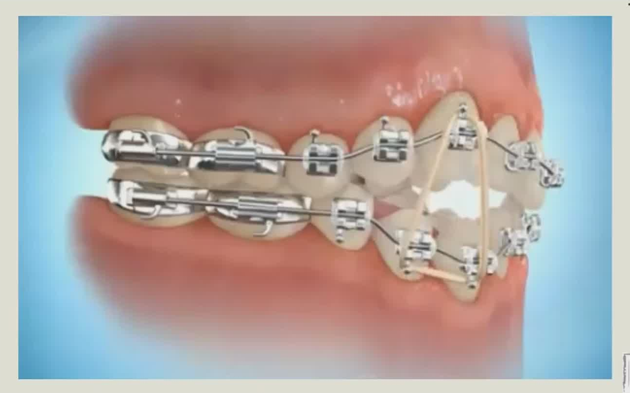 正畸技巧运用和动画演示(共56节)—口腔正畸课程哔哩哔哩bilibili