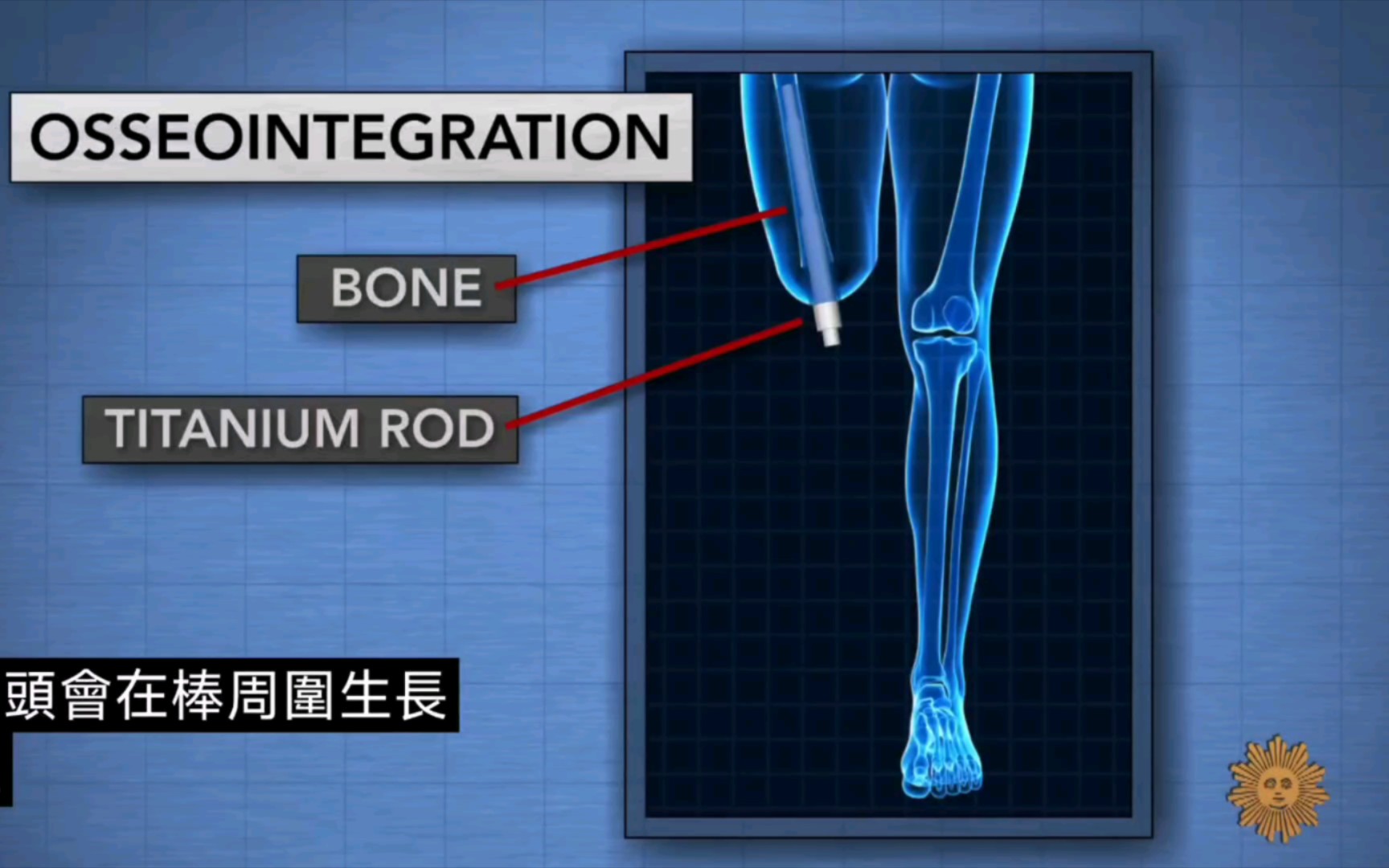 A giant step forward in artificial legs这是假肢的巨大进步哔哩哔哩bilibili