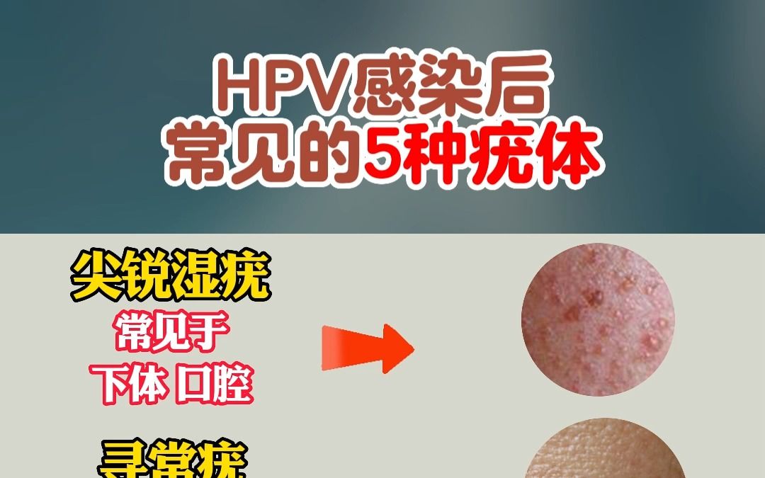 hpv感染後常見的5種疣體!