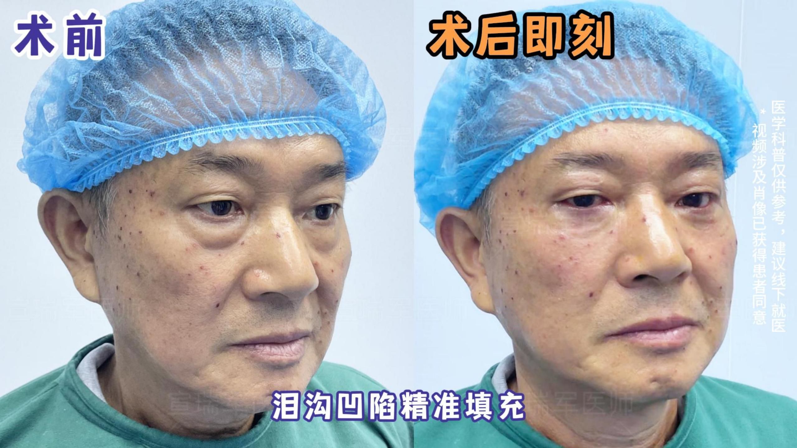 手术实拍:61岁重度眼袋,不开刀30分钟解决了!你有同款眼袋吗