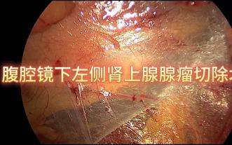 腹腔镜下左侧肾上腺腺瘤切除术