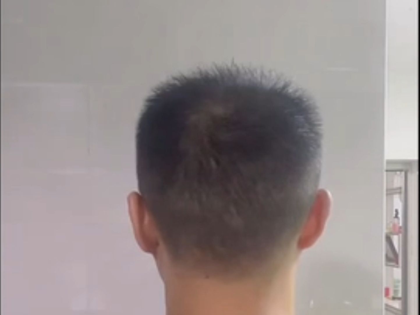 植发发发际线后移(植发际线后面的头发怎么办)