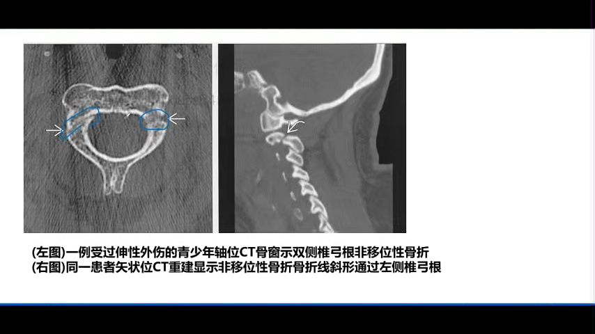 危急值(急诊)影像诊断精品课程:11.c2缢死性骨折