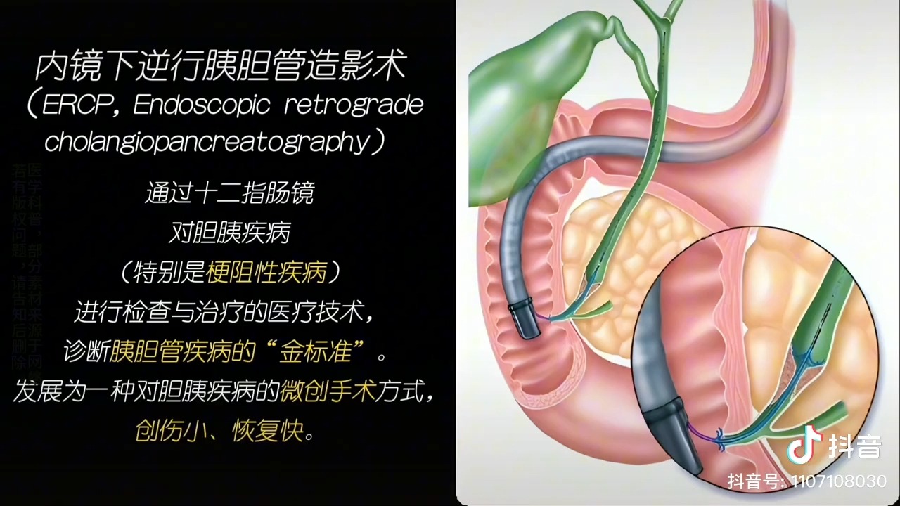 ercp哔哩哔哩bilibili