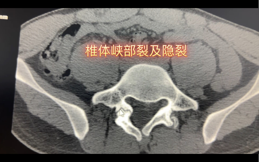 先天性峡部裂图片