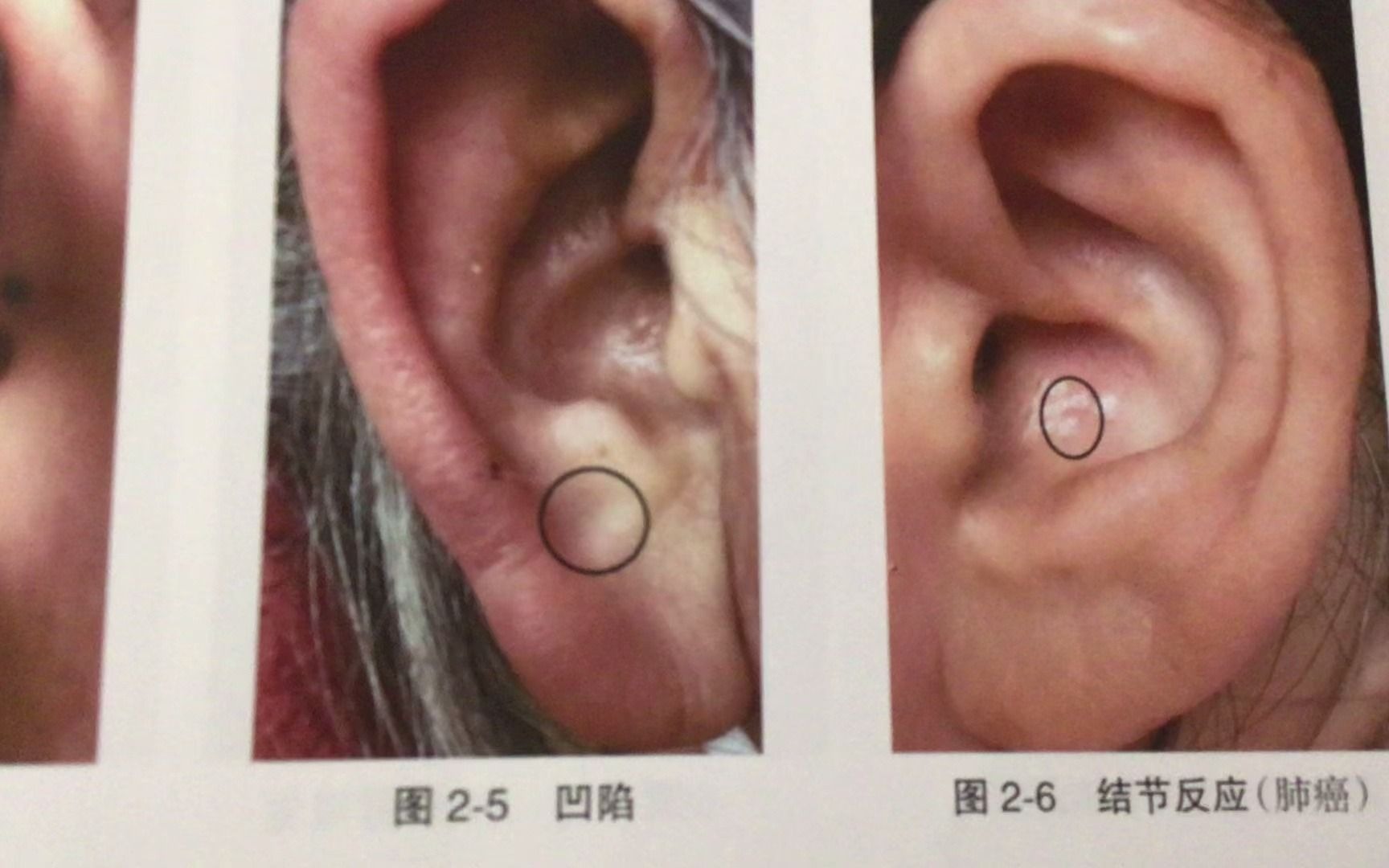 [图]2耳穴望诊