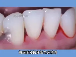 下载视频: 南京看牙：牙周炎严重不处理的后果