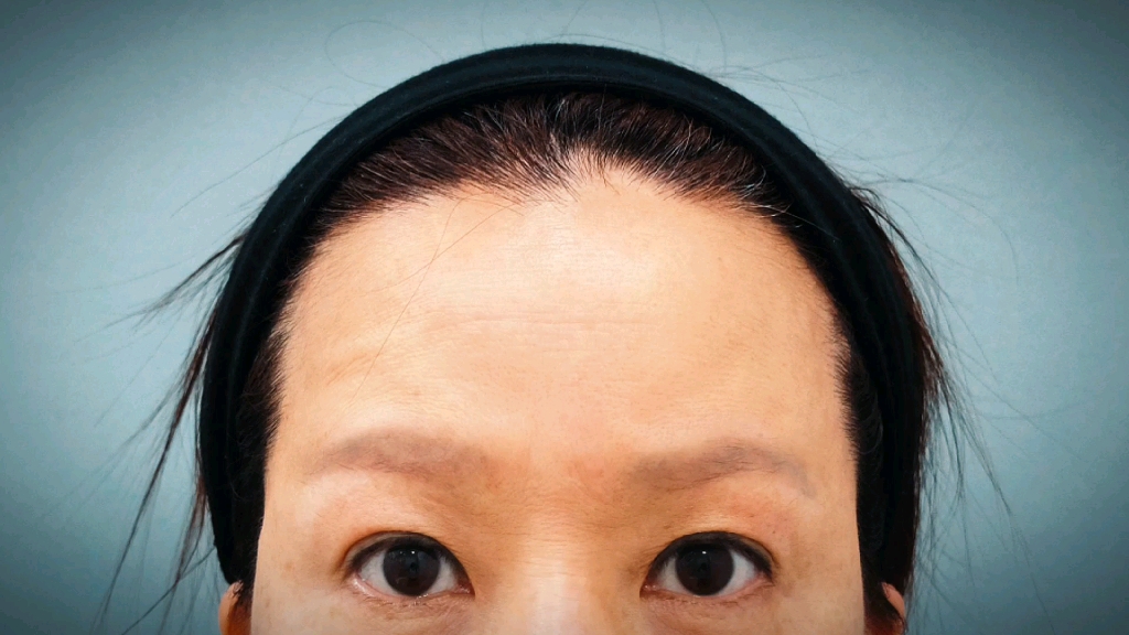 内窥镜额头提升77缩小——额头细纹,高低眉,眉压眼的问题统统可以