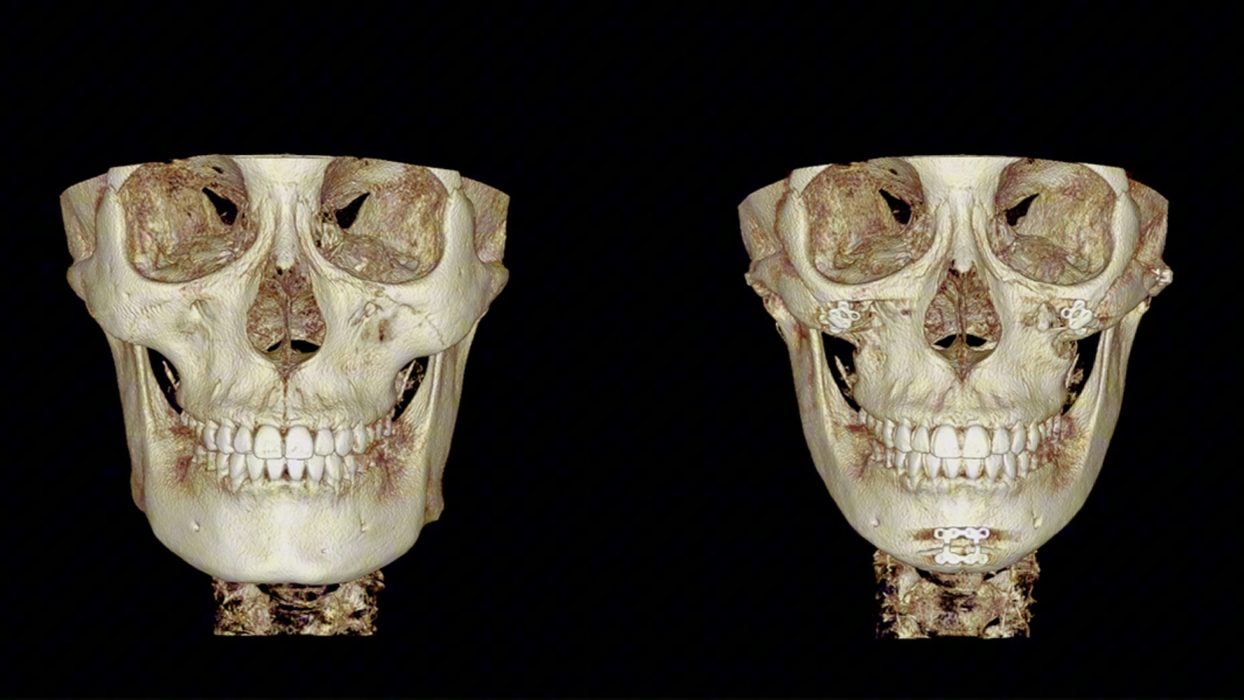 韩国1%轮廓三件套ct