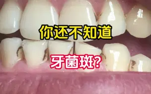 什么是牙菌斑？牙菌斑是如何形成的？