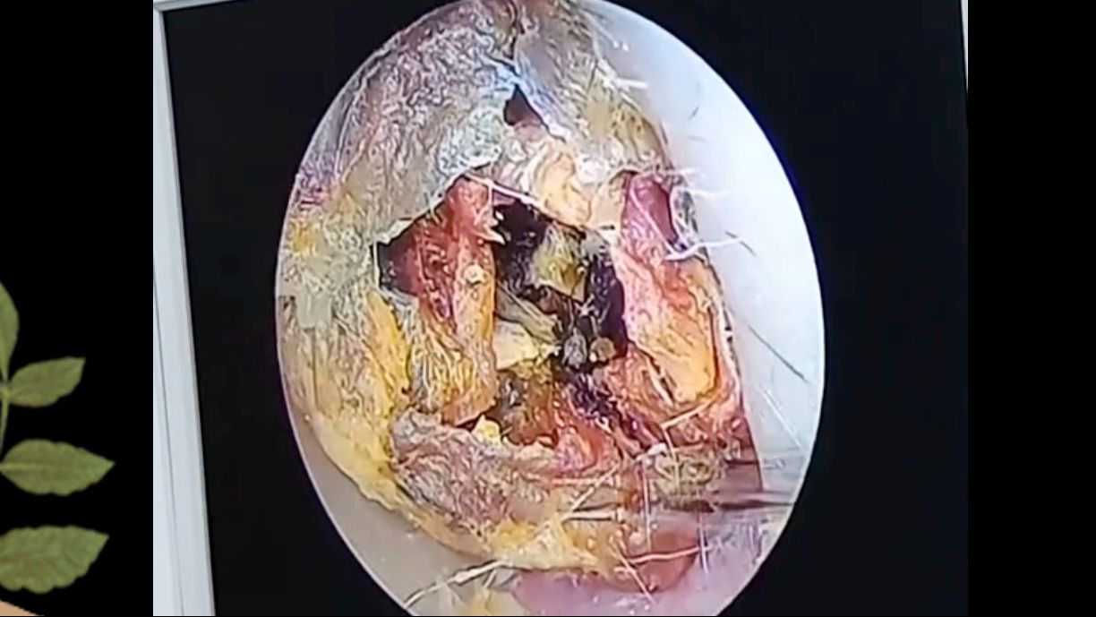 耳朵胆脂瘤手术图片图片