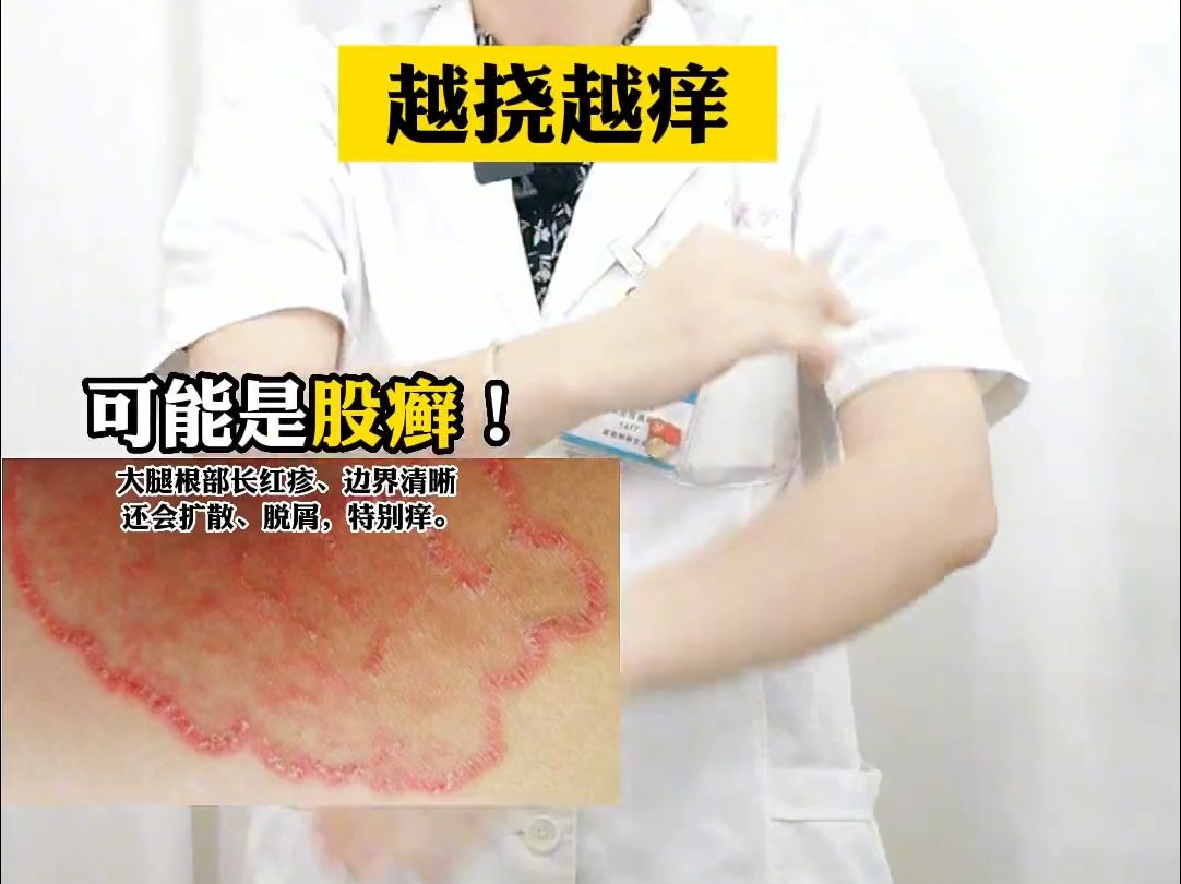 大腿根股癣 治疗方法图片