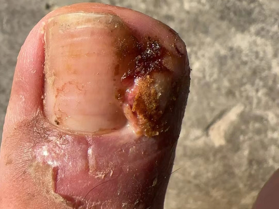 江苏徐州甲沟炎息肉客户,使用咱家产品,直接把大疙瘩息肉去掉,非常