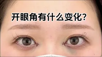 Download Video: 开眼角有什么变化？