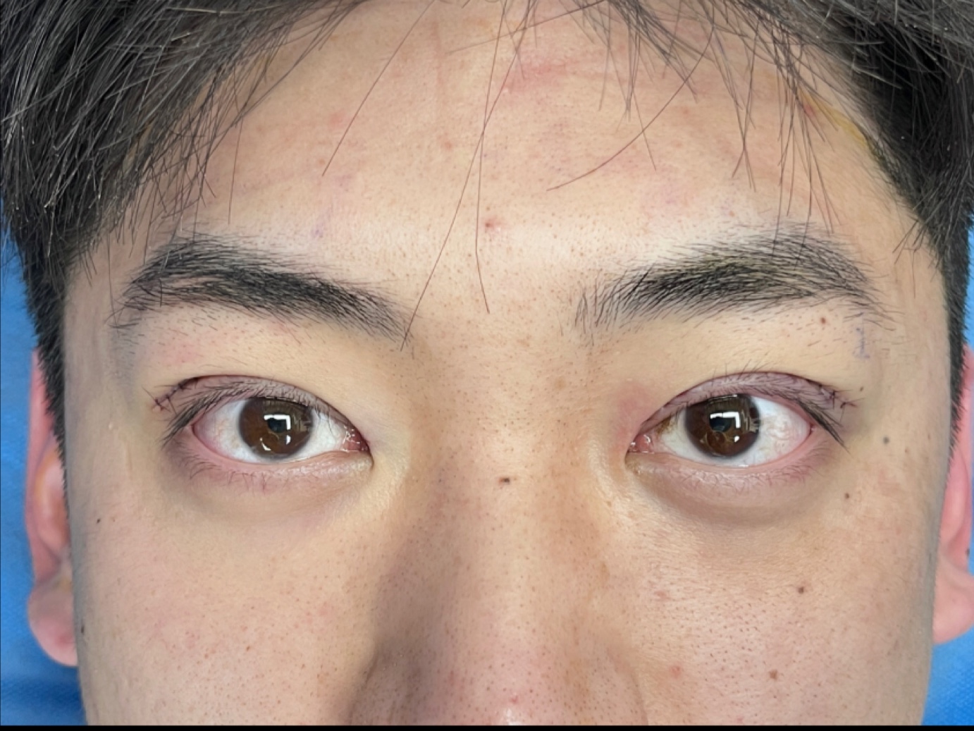 男生眼睛宽改窄 7mm改到4mm 尽显英气!