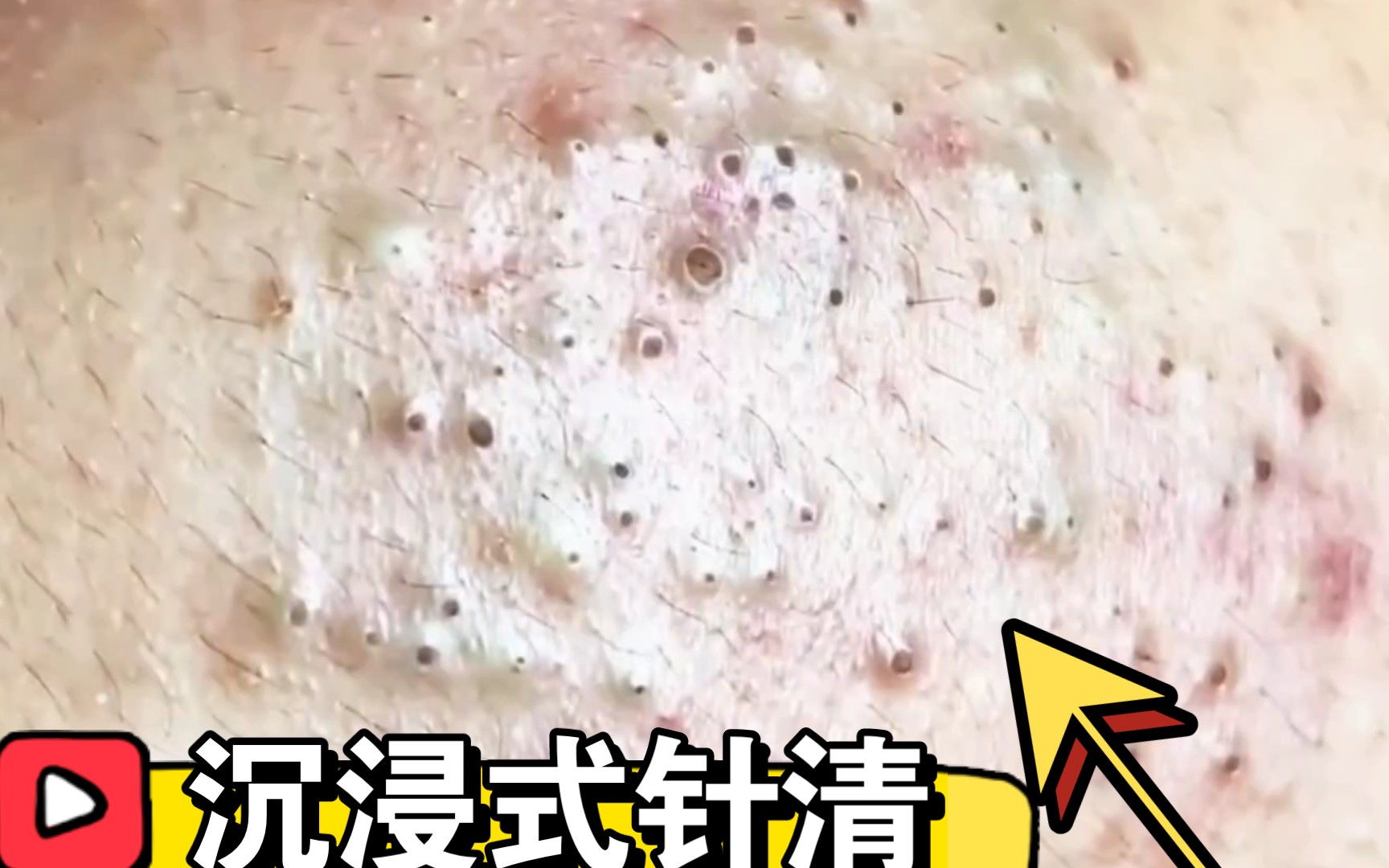 式全脸祛黑头放松|毛孔清洁|皮肤管理油皮痘肌|粉刺|针清|皮肤管理