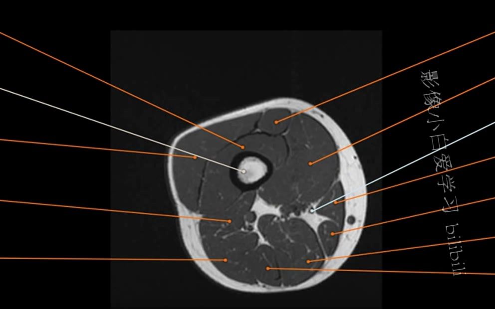 大腿肌群mri解剖图片