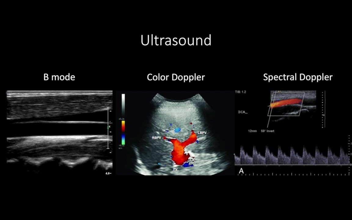 【Ultrasound Doppler Part 1】超声多普勒原理哔哩哔哩bilibili