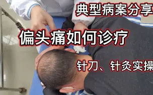 Download Video: 典型病案分享，枕神经卡压-偏头痛怎么治疗，针刀、针灸实操