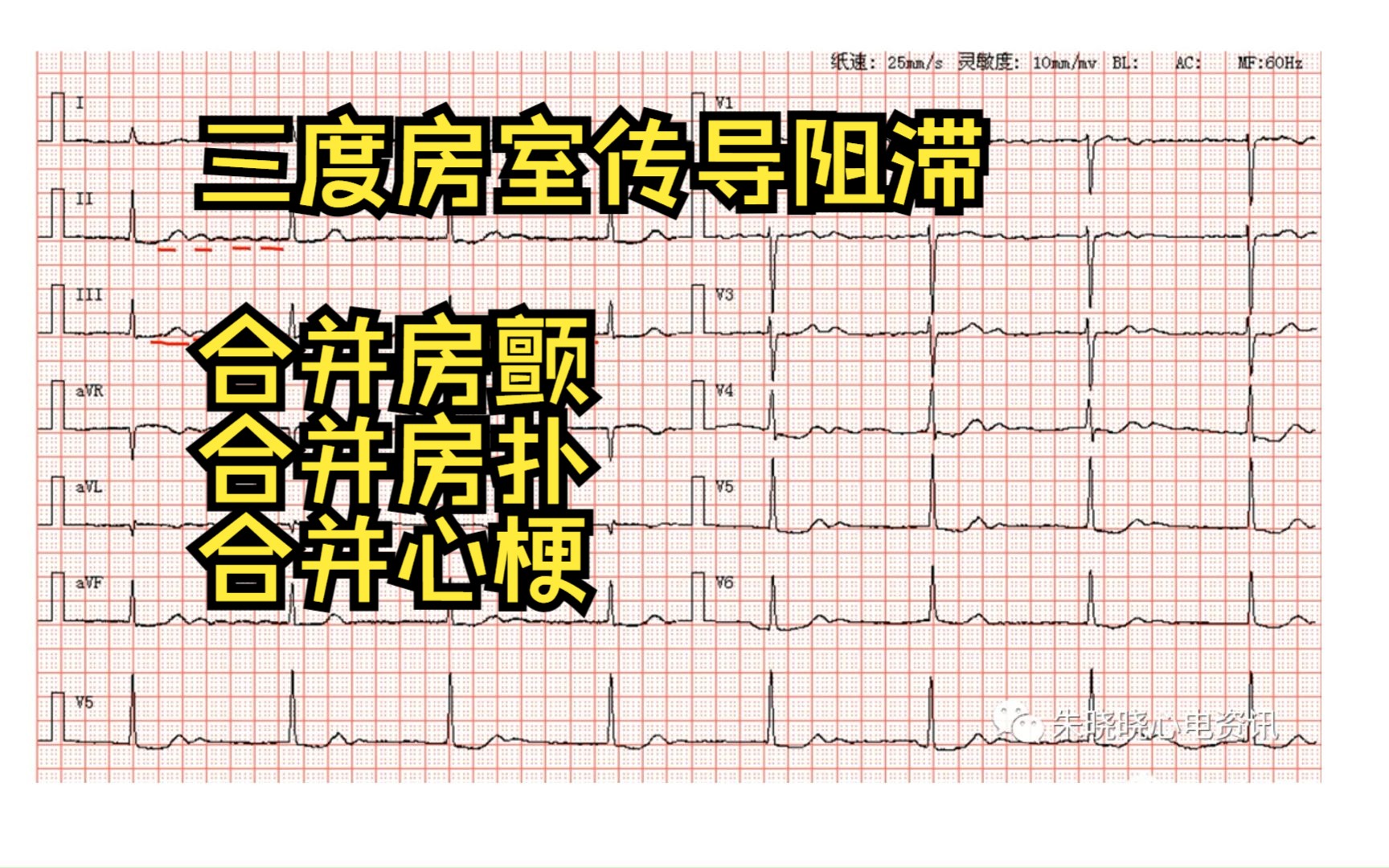 【心电图学习5】| 三度房室阻滞合并心梗,合并房颤,合并房扑哔哩哔哩bilibili