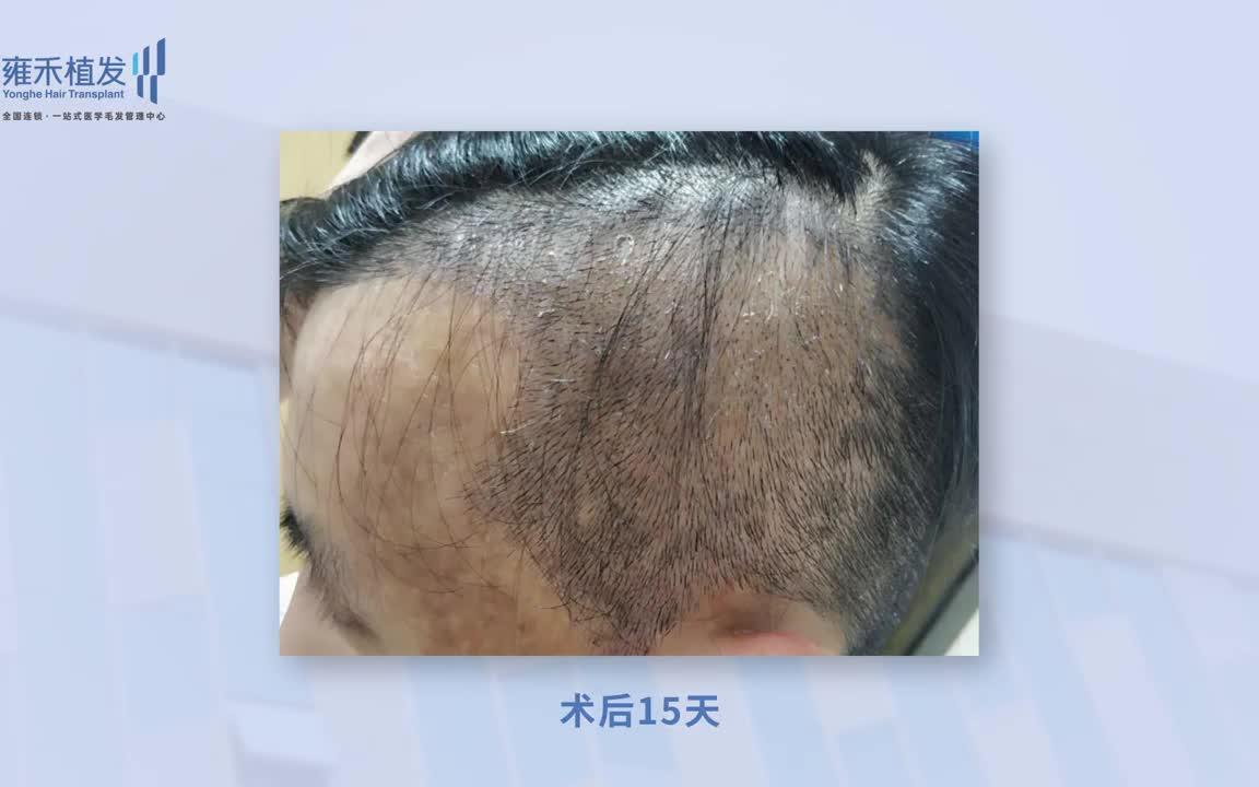 珠海男士疤痕植发种植术后案例效果分享!3285单位Yonghe hair transplant哔哩哔哩bilibili