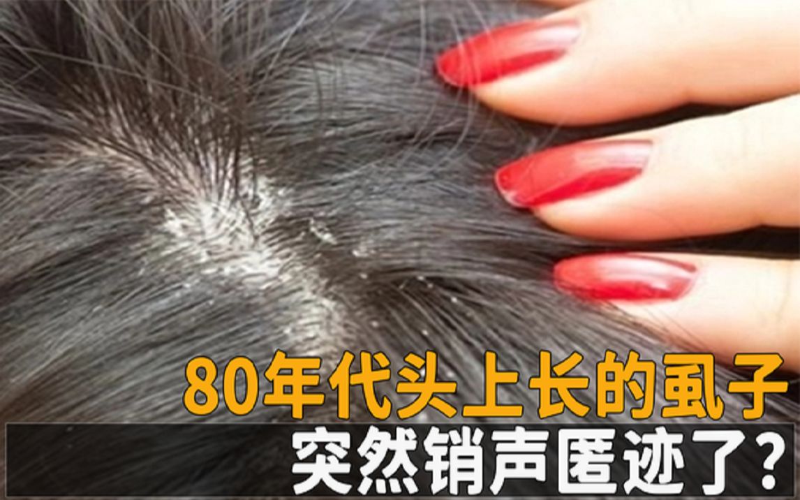 80年代头上长的虱子,为何突然销声匿迹了,虱子已经灭绝?哔哩哔哩bilibili