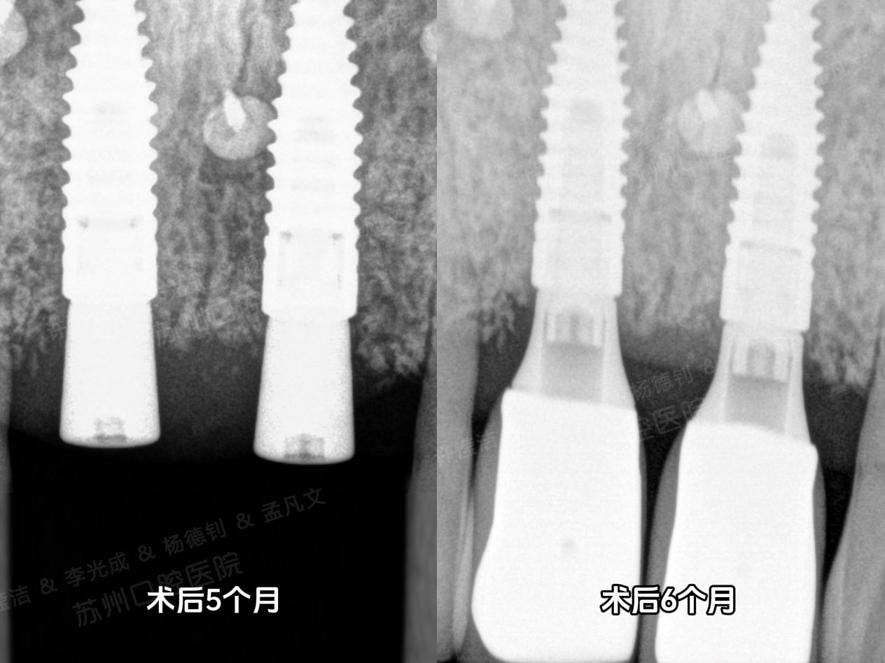 前牙区 GBR骨增量 鱼鳞状滋养孔 种植牙 本病例使用骨膜为博纳膜(天然猪心包脱细胞外机质)可吸收生物膜哔哩哔哩bilibili