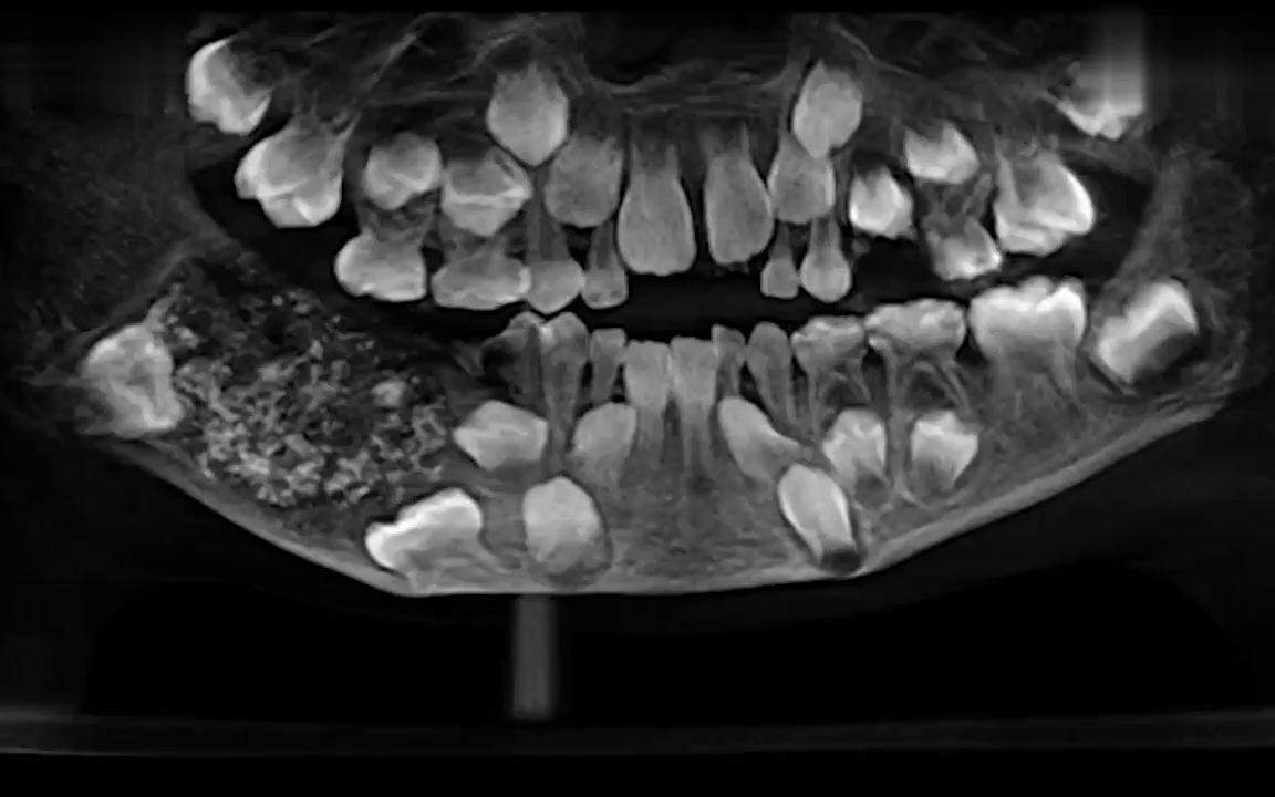 世界上牙齿最多的人,嘴里多长了526颗牙齿,简直不忍直视!#牙齿奇闻#哔哩哔哩bilibili