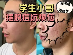 Tải video: 学生小哥摆脱痘坑烦恼