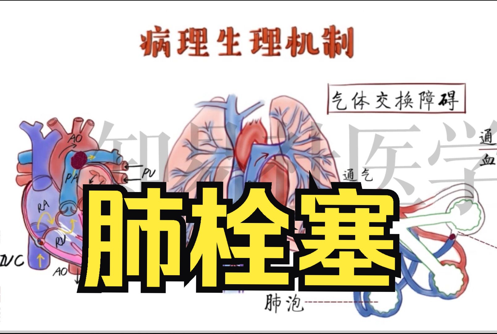 绘画医学 肺栓塞哔哩哔哩bilibili