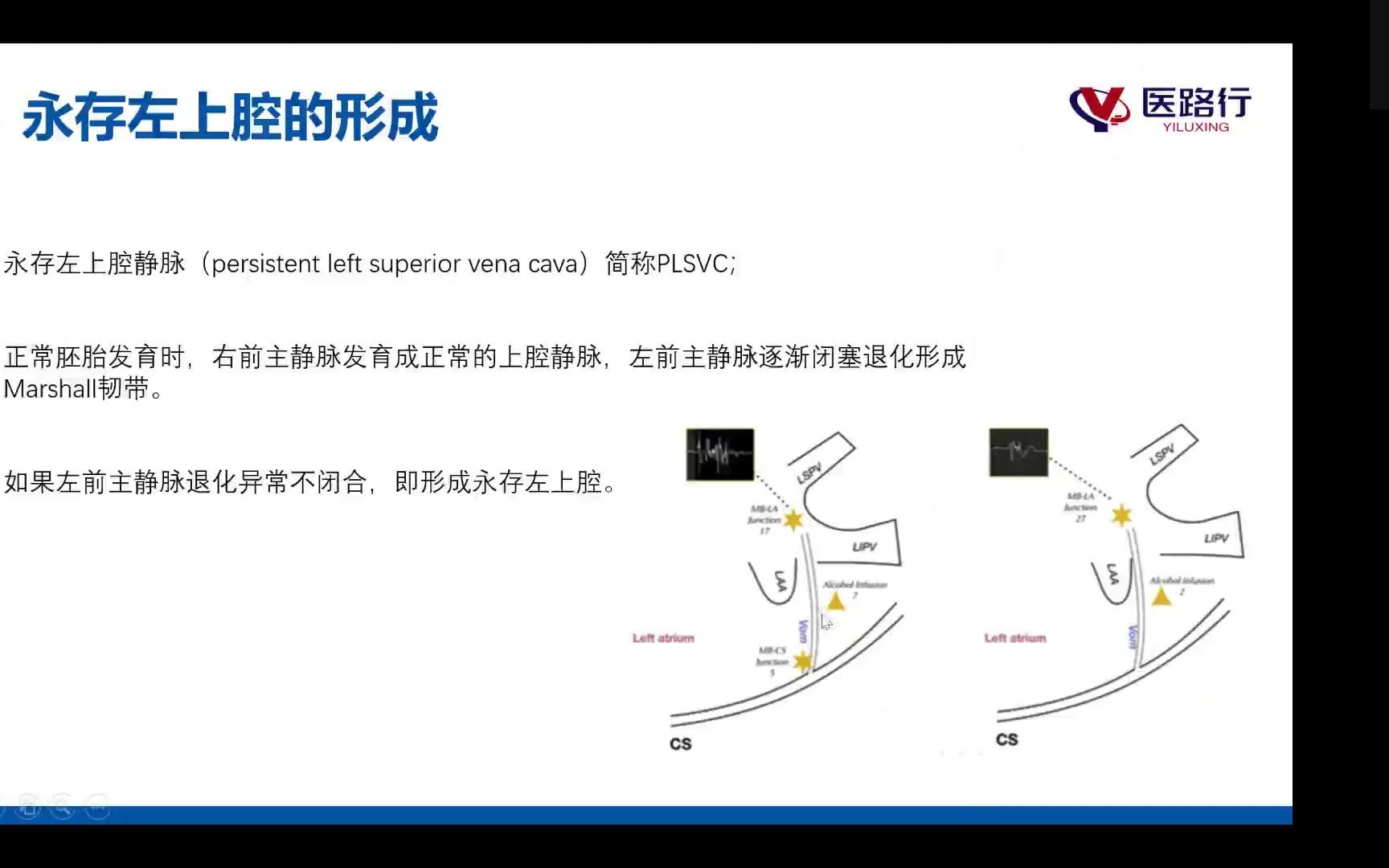 永存左上腔介绍及手术跟台中注意事项哔哩哔哩bilibili