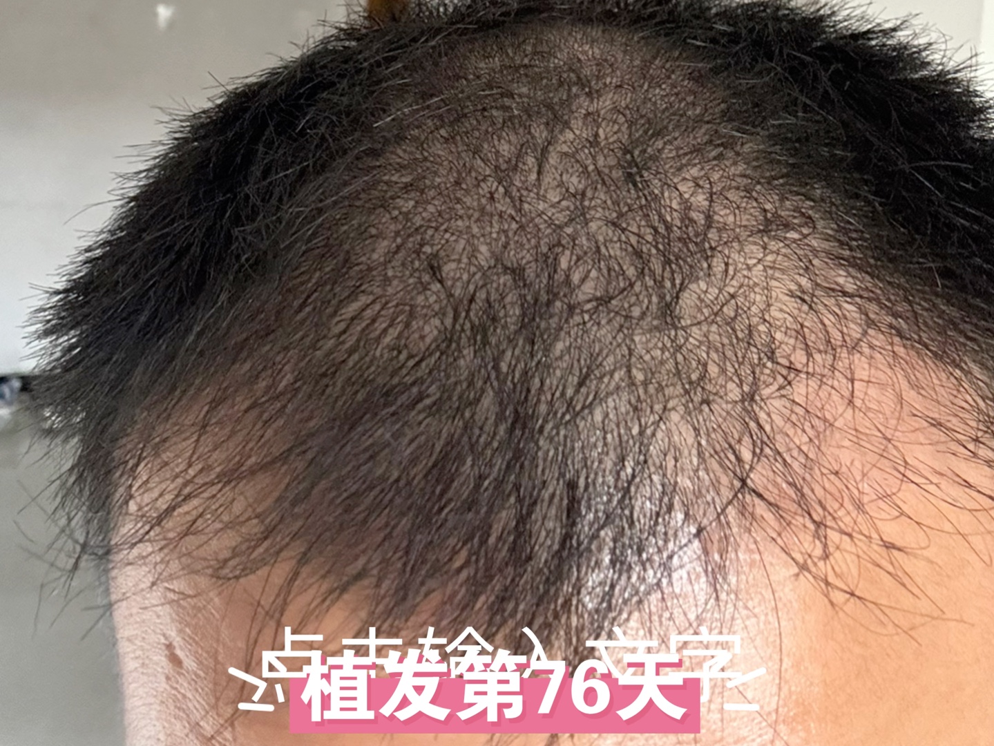植发终生(植发是永久生发吗)