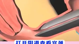 阴道镜检查全过程，到底有多疼