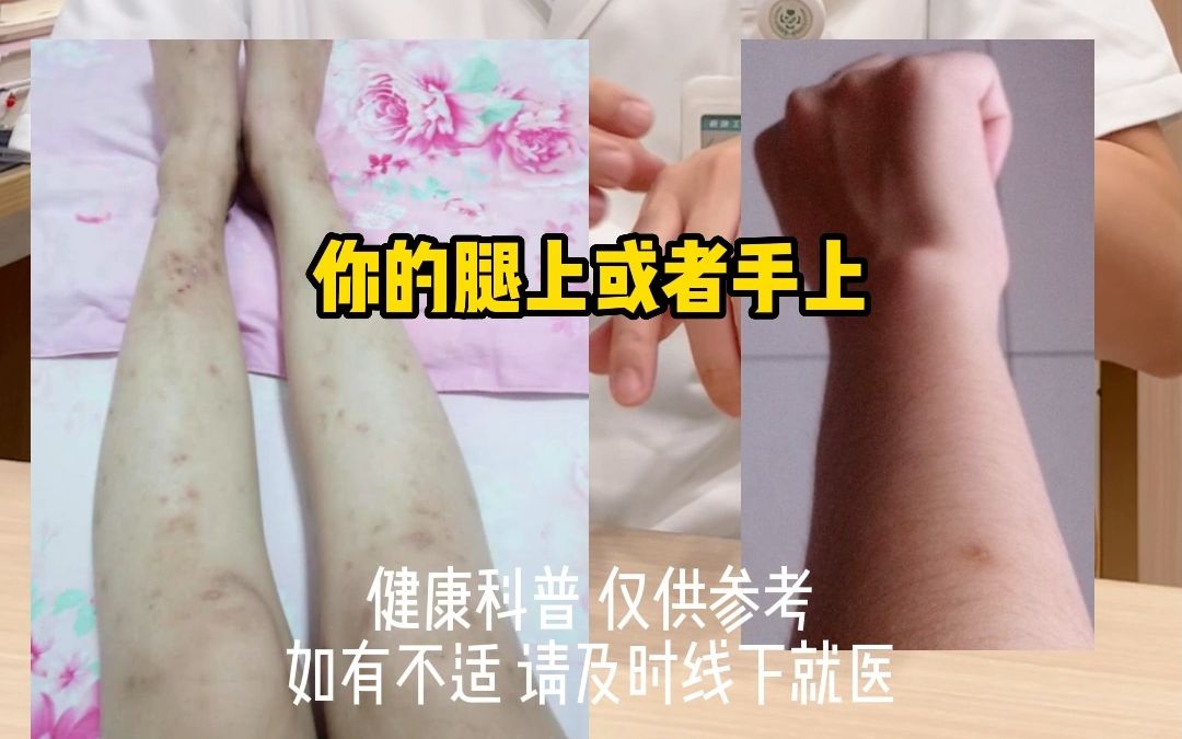 蚊子叮咬后留下的色素疤,该怎么救?哔哩哔哩bilibili