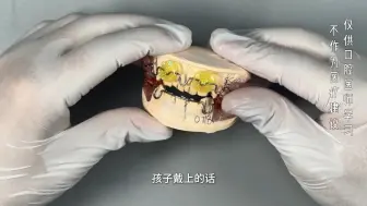 Descargar video: 法兰克3型牙齿矫治器 妃她正畸 儿童牙齿矫正 活动矫治器